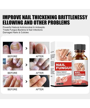 Buy Tlopa Nail Growth and Strengthening Serum - Nail Repair Solution (2 Pieces) for Stronger Healthier Nails Worldwide - Buy Online on SooperMarket.com