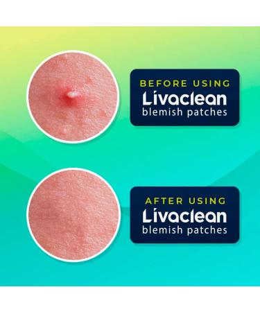 Livaclean (240 Count 6 Pack) Mixed bundle of Regular (96) Salicylic Acid (72) and T.Tree (72) Hydrocolloid Patches 6 Pack - 240 Count - Buy Online on SooperMarket.com
