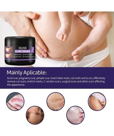 Scar Repair Cream | Acne Scar Removal | Pigmentation Corrector - 10/30/50g - Buy Online on SooperMarket.com