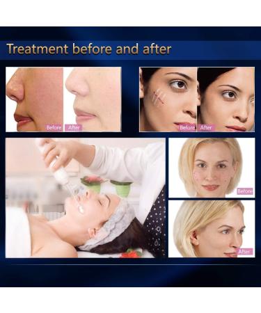 Titoe High Frequency Facial Wand - Multi-Function Face Care Device - Buy Online on SooperMarket.com