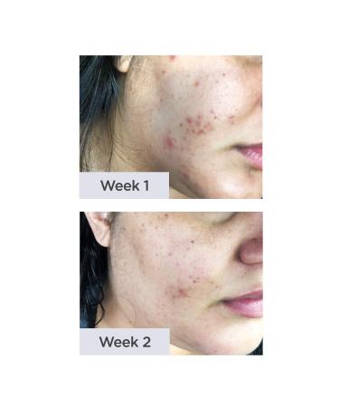 Buy NXN Acne Scar Treatment Gel | Antioxidants & Glycerin for Rapid Blemish Reduction - Effective Face & Body Solution - Buy Online on SooperMarket.com