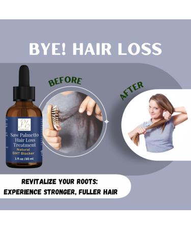 Saw Palmetto Hair Loss Treatment - Essential Oils for Hair Growth Strengthen Roots & Reduce Hair Loss - Buy Online on SooperMarket.com
