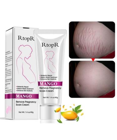 Mango Stretch Marks and Scar Cream, Stretch Marks and Scar Removal Cream for Pregnancy, Stretch Marks Scar Bellly Creams for Wrinkles, Obesity Stretch Mark Moisturizing, Remove Marks (40g)