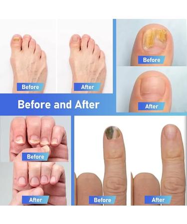 XIFEPFR Toenail Repair Pen - Nail Fingernail Repair Pen for Thick  Broken  Discolored Nails - Restores Healthy Strong Nails - 4PCS - Buy Online on SooperMarket.com