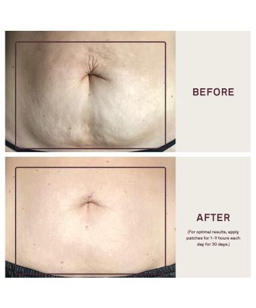 Buy Dermaclara Silicone Stretch Marks Patch Kit - Effective One Patch Solution for Scars | International Shipping Available - Buy Online on SooperMarket.com