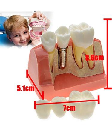 Dental Implant Analysis Demonstration Model - Crown Bridge Teeth Interpretation Model - Buy Online on SooperMarket.com