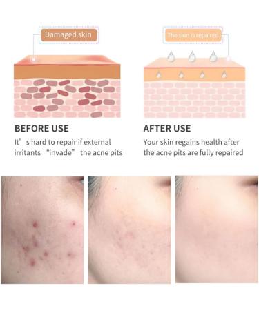 Acne Scar Removal Gel Face Body Marks Skin Repair Cream Acne Treatment Essence 30g acne removal cream - Buy Online on SooperMarket.com
