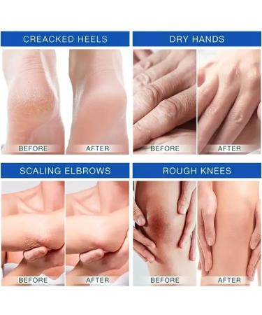 Tongyend Urea Foot Cream Cracked Heel Repair Cream 45% Urea Cream for Feet Callus Remover For Dry And Hard Skin Hydrates and Softens Dry Feet Callus Remover Nourishes Soften For Feet Knees Hand - Buy Online on SooperMarket.com