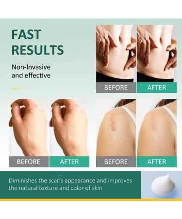 30g Scar Repair Cream | Reduces Stretch Marks, Burns & Acne Scars | Skin Smoothing Treatment - Buy Online on SooperMarket.com