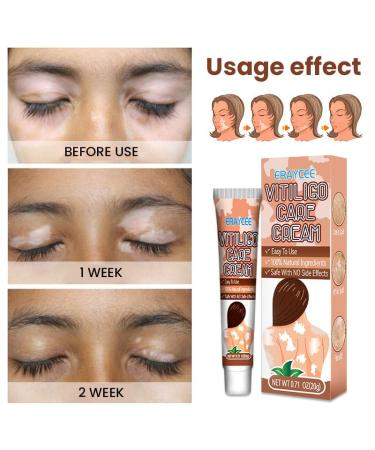 Natural Vitiligo Cream - Effective Treatment to Reduce White Spots & Improve Skin Pigmentation | International Shipping - Buy Online on SooperMarket.com