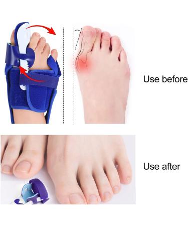 Bunion Toe Separator for Pain-Free Movement | Adjustable Strength | Comfortable Soft Fabric | Right Toe Splint for Daily Use - Buy Online on SooperMarket.com