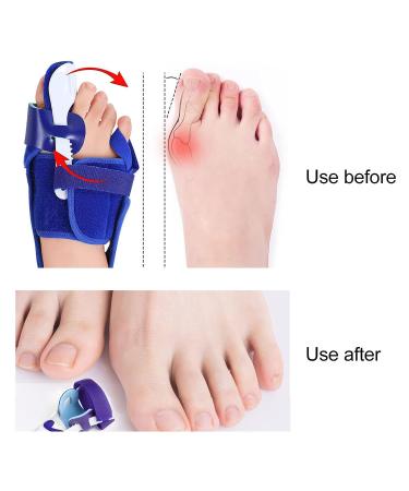 Bunion Toe Separator & Straightener for Hallux Valgus Correction - Toe Spacer & Overlapping Toes Corrector for Men and Women (Right) - Buy Online on SooperMarket.com