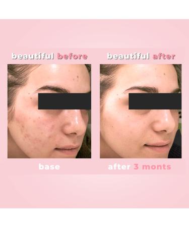 Buy Acne Out Mattifying Lotion - Clear Skin Solution | International Shipping Available - Buy Online on SooperMarket.com