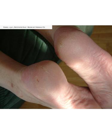 Natural Products Black Callus Ex - Effective Callus Remover & Foot Cream 50ml | Best Foot Care Solution - Buy Online on SooperMarket.com