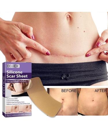 WAITLOVER Skin Color Reusable Silicone Scar Removal Patch - Surgical Self-Adhesive Soft Gel Strip for Burn Repair - Buy Online on SooperMarket.com
