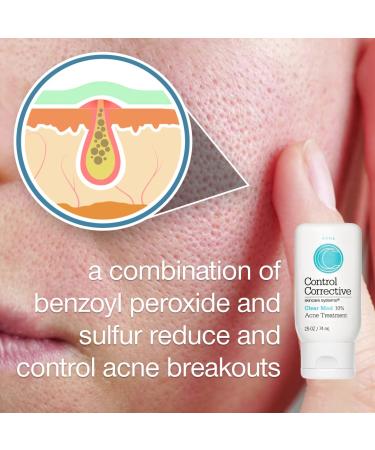 CONTROL CORRECTIVE Clear Med 10% Acne Treatment Lotion - 2.5 Oz | Benzoyl Peroxide & Sulfur Formula for Breakouts | Kills Acne Bacteria, Dries Blemishes - Buy Online on SooperMarket.com