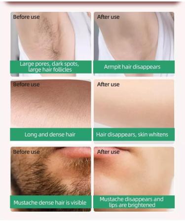 Laser Hair Removal for Women - Permanent Painless IPL Device with 999,999 Flashes, 5 Energy Levels, 2 Modes - Ideal for Face, Body, Bikini - Deep Green - Buy Online on SooperMarket.com