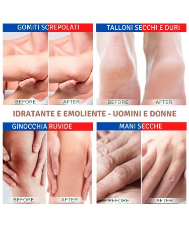 TIS CREME with 15% Urea - Eczema Psoriasis Dry Skin Relief | Wound Healing for Hands Feet Knees & Nails | 50 ml Pack - Buy Online on SooperMarket.com