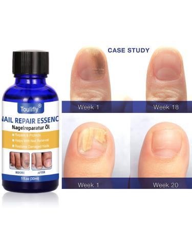 Premium Nail Care & Treatment | Repair Broken & Discolored Nails with Nourishing Nail Oil & Serum for Healthy Hands & Feet - Buy Online on SooperMarket.com