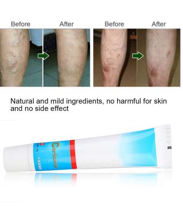 Varicose Vein Treatment Cream - Reduce Inflammation, Improve Circulation | Vein Lotion for Legs & Body - Buy Online on SooperMarket.com