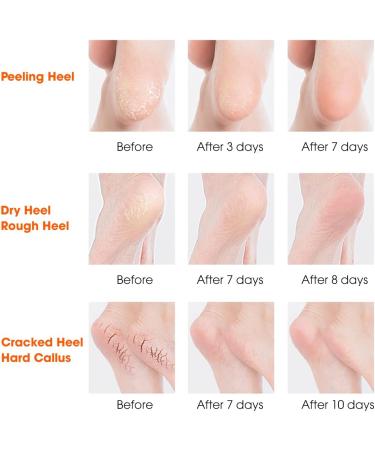 Nado Care Large Moisturizing Gel Socks for Dry Cracked Heels - 5 Pair Set - Buy Online on SooperMarket.com