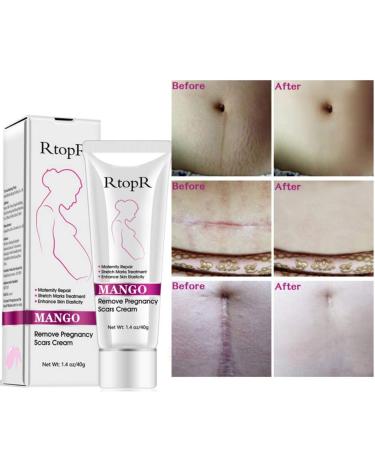 Ofanyia Stretch Mark Removal Cream - Effective Repair for Scars & Pregnancy Marks | International Shipping - Buy Online on SooperMarket.com