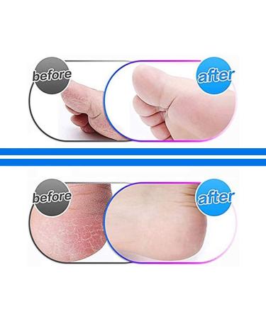 Gearmax 4 Pcs Mineral Replacement Rollers Super Coarse Micro Mineral Replacement Rollers Compatible with Emjoi Micro Pedi Callous Remover for Extremely Rough and Tough Calluses - Buy Online on SooperMarket.com
