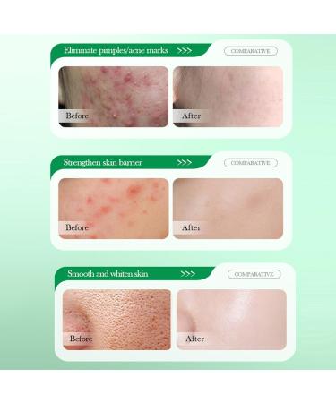 Salicylic Acid Repair Cream - Face Moisturizer for Acne-Prone Skin | Pore Shrinkage & Scar Improvement | 50g - Buy Online on SooperMarket.com