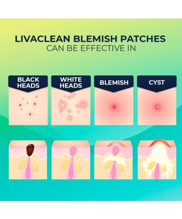 Livaclean (240 Count 6 Pack) Mixed bundle of Regular (96) Salicylic Acid (72) and T.Tree (72) Hydrocolloid Patches 6 Pack - 240 Count - Buy Online on SooperMarket.com