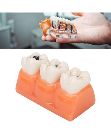 4-Fold Dental Caries Model - Synthetic Resin Oral Care Training Tool for Students | Safe & Realistic Simulation - Buy Online on SooperMarket.com