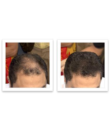 Dark Brown Hair Loss Concealer Trial Size - Cover Bald Spots Instantly - 10-Day Supply - All-Natural Fiber Formula - Buy Online on SooperMarket.com