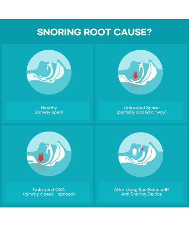 Anti Snoring Mouth Guard Device: Medium Anti Snoring Devices Ronflement Solution - Stop Snore Guard Mouthpiece Sleeping Mouth Stopper - Sleep Apnea Devices (Blue) - Buy Online on SooperMarket.com