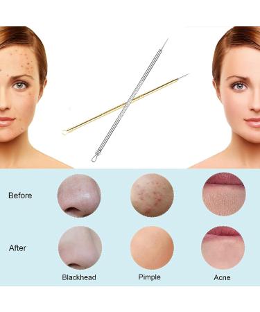 Blackhead Remover Kit - 2 PCS Pimple Popper Tool for Face & Nose | Blackhead & Whitehead Removal Treatment Tool - Blemish & Acne Extractor Set - Buy Online on SooperMarket.com