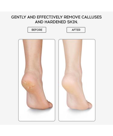 Layhou Foot File Foot Scrubber Callus Remover for Feet Foot Rasp foot file and Callus remover(Metal Foot File) - Buy Online on SooperMarket.com