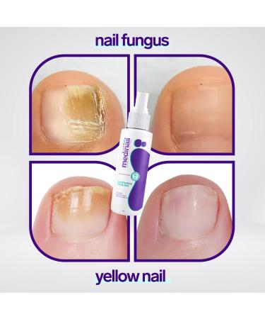 Medinail Fungus Spray - Advanced Nail Fungus Treatment and Strengthener 3.38 Fl Oz - Buy Online on SooperMarket.com