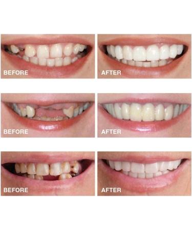 2 Pairs Veneers Dentures - Temporary Tooth Repair for Imperfect Teeth - Buy Online on SooperMarket.com