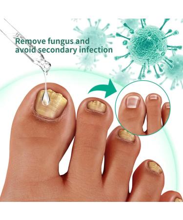 Nail Fungus Removal Liquid - Natural Toenail Fungus Oil for Effective Nail Care | BTSEURY - Buy Online on SooperMarket.com