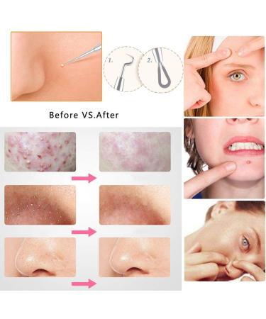 Ellolife 5-Pack Blackhead Remover Set - Stainless Steel Comedone Squeezer Kit for All Skin Types | Acne and Whitehead Extraction - Buy Online on SooperMarket.com