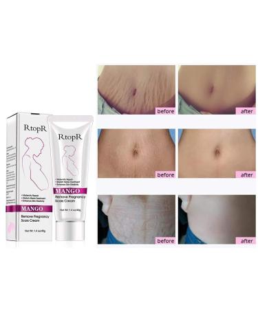 RtopR Mango Stretch Marks & Scar Cream - Pregnancy Safe Moisturizer - 80g (Pack of 2) - Buy Online on SooperMarket.com