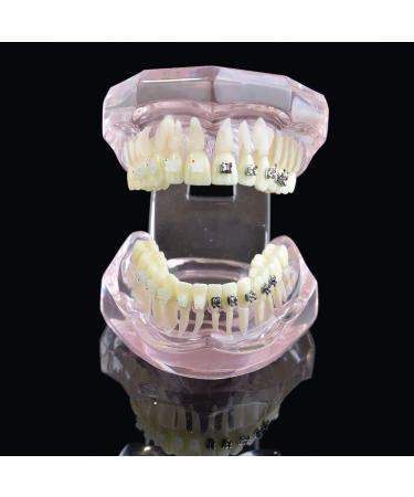 LBYLYH Orthodontic Demonstration Model - Teeth Teaching Tools with Metal & Ceramic Support for Effective Dental Treatment - Buy Online on SooperMarket.com