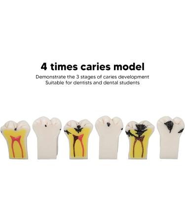 4-Fold Dental Caries Model - Synthetic Resin Oral Care Training Tool for Students | Safe & Realistic Simulation - Buy Online on SooperMarket.com