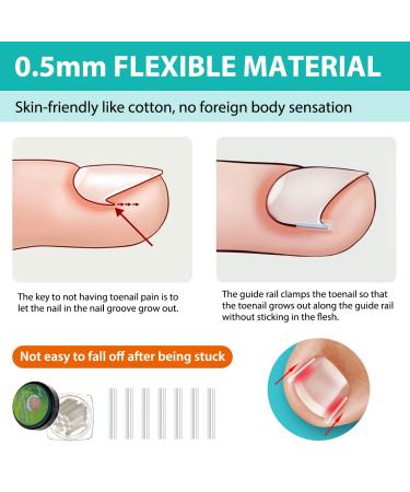 152-Piece Ingrown Toenail Tool Set | Toenail Correction Patch Clasp & Files for Pain Relief - Ship Internationally - Buy Online on SooperMarket.com