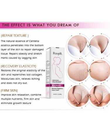Ofanyia Stretch Mark Removal Cream - Effective Repair for Scars & Pregnancy Marks | International Shipping - Buy Online on SooperMarket.com