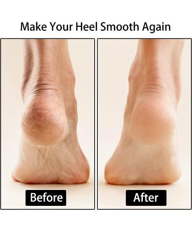 Moisturizing Toeless Silicone Socks for Women - 6pcs | Dry Cracked Heel Treatment - Buy Online on SooperMarket.com