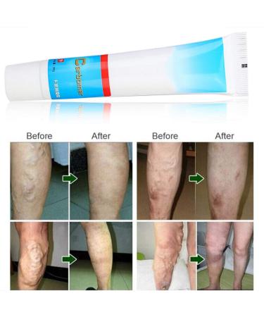Varicose Vein Treatment Cream - Reduce Inflammation, Improve Circulation | Vein Lotion for Legs & Body - Buy Online on SooperMarket.com