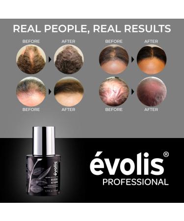 volis REVERSE Activator Hair Growth Treatment - Keratin Formula for Thinning Hair - Accelerates Growth, Reduces Hair Fall - Scalp Treatment for Hair Regrowth (1.7 fl oz) - Buy Online on SooperMarket.com