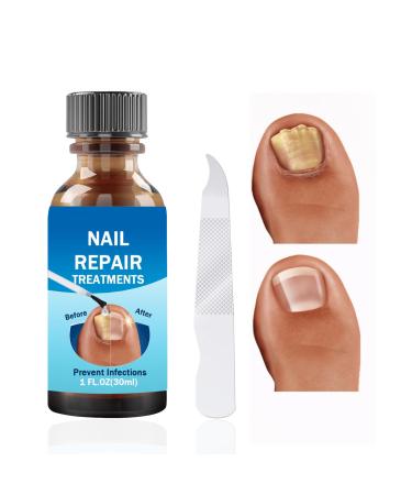 Fungal Nail Treatment 30ML Nail Fungus Serum for Toenail Extra Strong Gentle Anti Fungal Nail Serum Protects Thick Broken Discolored Nails Restoring Healthy Nails For Finger And Toe Nail Fungal