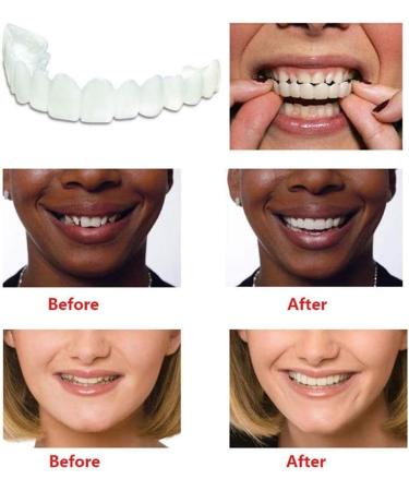 Xiaocui Provisional Dentures - Instant Perfect Smile | Comfort Fit Flex Teeth Veneers & Cosmetic Stickers for All Sizes - Buy Online on SooperMarket.com