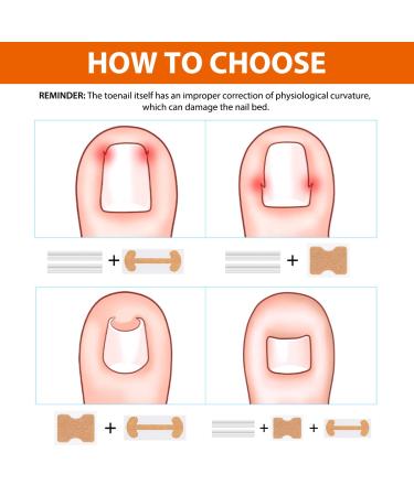 152-Piece Ingrown Toenail Tool Set | Toenail Correction Patch Clasp & Files for Pain Relief - Ship Internationally - Buy Online on SooperMarket.com