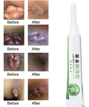 Semme Hemorrhoids Ointment Cream - Fast Relief for Internal & External Piles, Anal Fissure (1 Pack) - Buy Online on SooperMarket.com